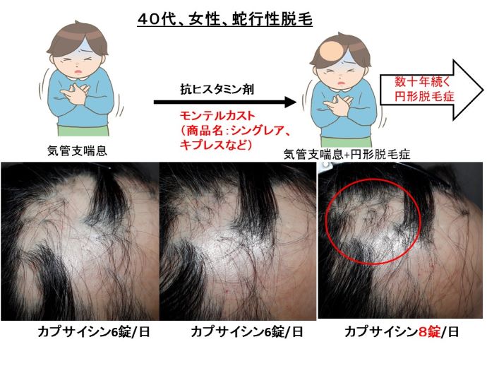 円形脱毛症　病院